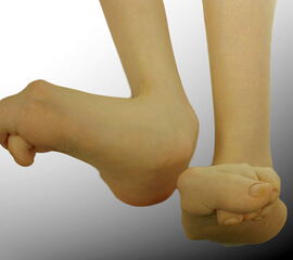 Abbildung 9: Schwerer neurogener Knick-Hackenfuß bei einem nicht gehfähigen Patienten mit Cerebralparese (GMFCS 5): Schuhversorgung wegen extremer Fehlstellung der Zehen nicht mehr möglich.