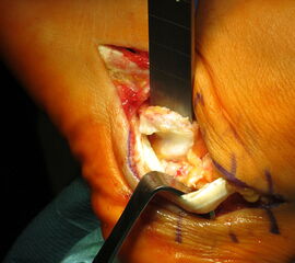 Offene Abtragung einer hypertrophen Christa peronealis.