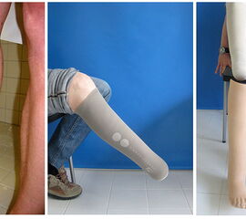 Unterschenkellange Syme-Prothese mit Silikonliner und partiellem Weichwandinnenschaft