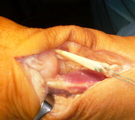 Langer Sehnenstumpf, der über eine Querbohrung durch den Kalkaneus gezogen wurde und mit sich selbst vernäht werden kann.