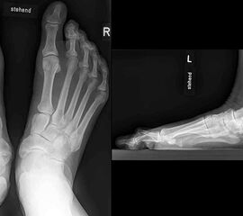 Stehende konventionelle Röntgenbilder eines Fußes mit Planovalgus Deformität Stadium II b dorsoplantar (dp) und seitlich. Auf der dp-Aufnahme zeigt sich die talo-calcaneare Divergenz, der gegenüber dem Kalkaneus nach anterior gleitende Talus und d