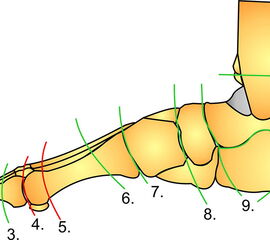 Schema der Amputationsniveaus am Fuß von der Seite.
Grün: empfohlene Amputationslinien.
Rot: nicht empfohlene Amputationslinie.