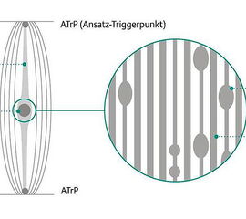 Triggerpunkt-Komplex (modifiziert nach: Simons, D. G.; Travell, J.; 1999): Muskelknoten (Zentraler Triggerpunkt) mit Verkürzungsstrang und Ansatz-Triggerpunkten (ATrP). (Mit frdl. Genehmigung durch Level-10-Buchverlag, Heilbron