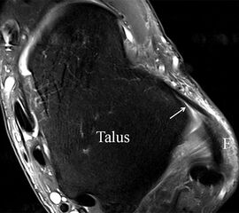 PD fs HR axial. Klare Darstellung eines filigranen, knapp über 1 mm breiten LFTA (Pfeil). Fibula (F).