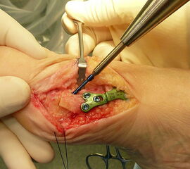 Osteosynthese des MT I subcapital mit Doppelgewindeschraube (Photo)