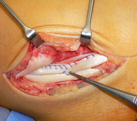 Naht eines Längsrisses der Peronaeus brevis Sehne