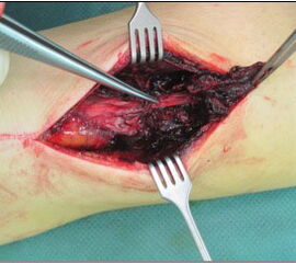 Intraoperativer Befund bei einer inkompletten Achillessehnenruptur