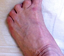 Klinisches Erscheinungsbild eines Hallux varus (eigenes Bildmaterial)