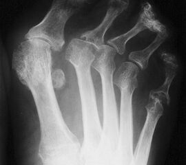 Dorsoplantare Darstellung des Vorfußes. Fortgeschrittene Destruktion des Metatarsophalangealgelenks am 5. Strahl und Lateraldeviation der Zehen.