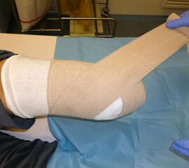 Der Amputationsstumpf wird mit einer elastischen Binde (Langzug) komprimiert. Das dient in der postoperativen Phase zur Blutstillung und im weiteren Verlauf der Stumpfkonfiguration.