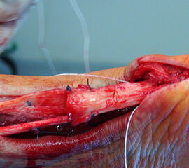 Grifflschachtelplastik nach Lange. Hierbei wird der Gewebesteifen komplett mobilisiert und nach distal verschoben. Die Sehnen bekommt bei dieser Technik eine gleichmäßigere Dicke, als bei der Umkehrplastik.