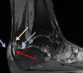Abbildung 4: Das MRT des Rückfusses zeigt die unterschiedlichen Veränderungen, die mit einer Insertionstendinopathie einhergehen. Die präachilläre und retrocalcaneare Bursitiden (Pfeile) kommen zur Darstellung, sowie die intratendinösen Veränderungen.