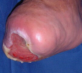 Problematik des nicht antagonisierten Sehnenzugs nach Lisfrancamputation. Die  Fußhebung ist ausgefallen. Durch Zug des M. trizeps surae resultiert eine Spitzfußstellung, die bei Neuropathie ein chronisches Ulkus im Bereich der Hauptbelastungszone hervorr