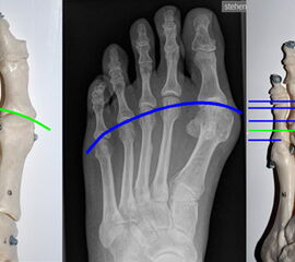 Metatarsaleköpfchenparabel nach Maestro und Pisani