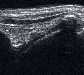 Impingement bei osteophytären Anbauten an der ventralen Tibia und am Talushals.