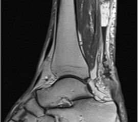 Langstreckige Sehnendegeneration nach veralteter Ruptur.