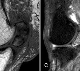 Die zystischen Veränderungen und die angrenzende Skleros