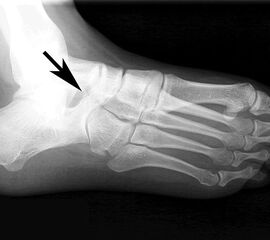 Röntgenbild (Fuß schräg) des Patienten aus Abb. 23 bis 26. Es zeigt sich eine Knochenbrücke zwischen Os naviculare und Calcaneus (Coalitio calcaneonavicularis).