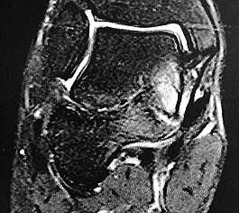 Z.n. Distorsion des Fußes mit „Ruptur“ der (vorbestehenden) talocalcanearen Coalitio. Die Wassereinlagerung in den an die Coalitio angrenzenden knöchernen Bezirken ist im MRT gut zu erkennen. Nach monatelangen Beschwerden spontane Besserung.