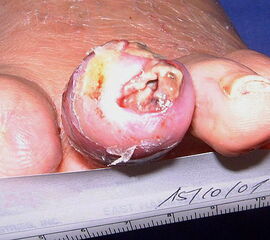 Eitrig-infiziertes Ulkus an der Spitze der 2. Zehe als Indikation zur Endgliedamputation.