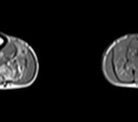 Fettige Degeneration des M. soleus. Abteile des M. gastrocnemius zeigen noch ein normales Signal im MRT.