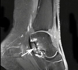 Aktivierte Coalitio der medialen Facette des Subtalargelenks im MRT.