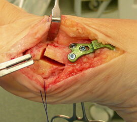 Subcapitale Korrektur nach Chevron mit medialer Keilentnahme – PASA Korrektur- (Photo)