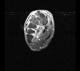 Tendinose der Peronaeus longus Sehne plantar.