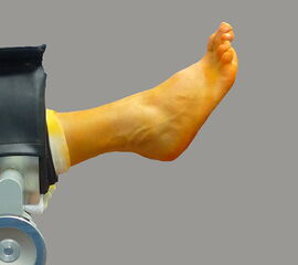 Mechanischer Beinhalter. Der Fuß sollte frei gelagert werden, die Ferse sollte nicht aufliegen, um einen Talusvorschub zu vermeiden.