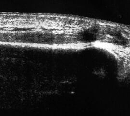 Ruptur der Tibialis anterior Sehne mit retrahiertem Stumpf und umgebendem Hämatom.