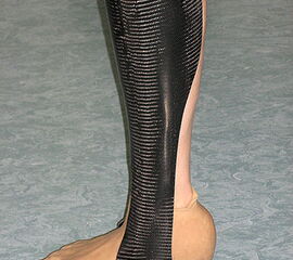 Silikon-Rückfußprothese mit unterschenkellanger Adaptivorthese aus Carbon- Prepreg